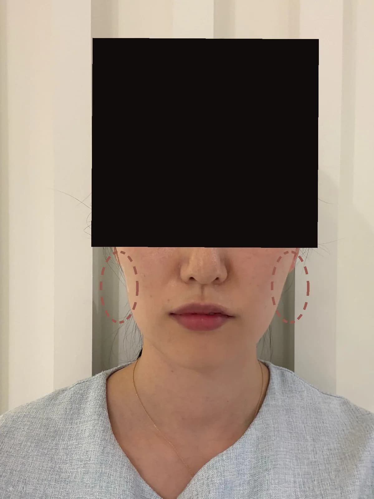 볼륨 실리프팅 시술 후