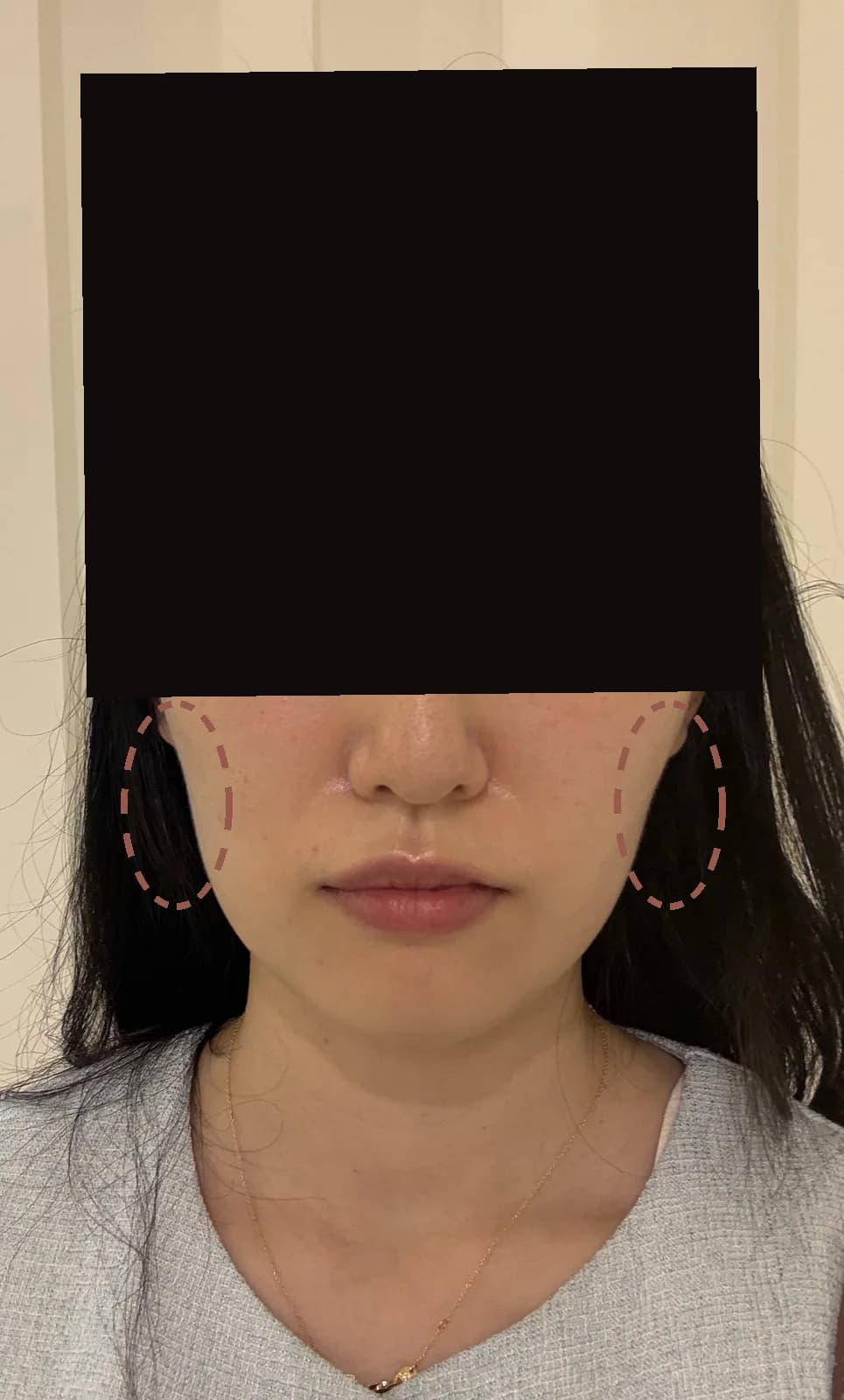 볼륨 실리프팅 치료 전