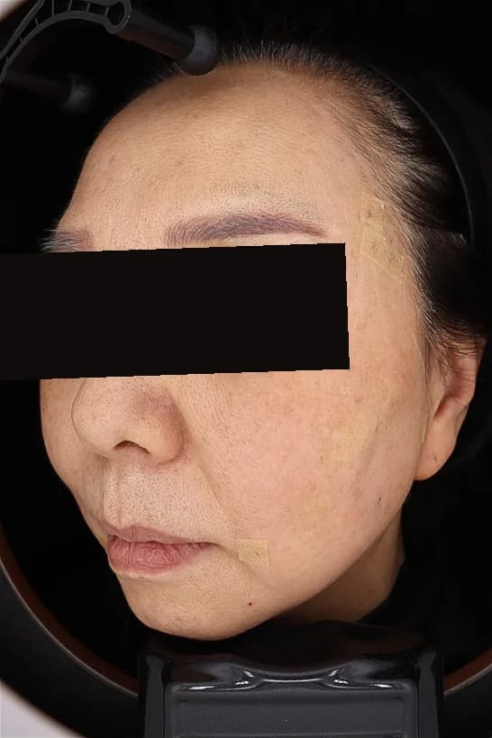 실리프팅 시술 직후